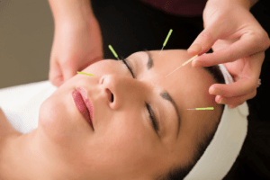 akupunktura kosmetyczna